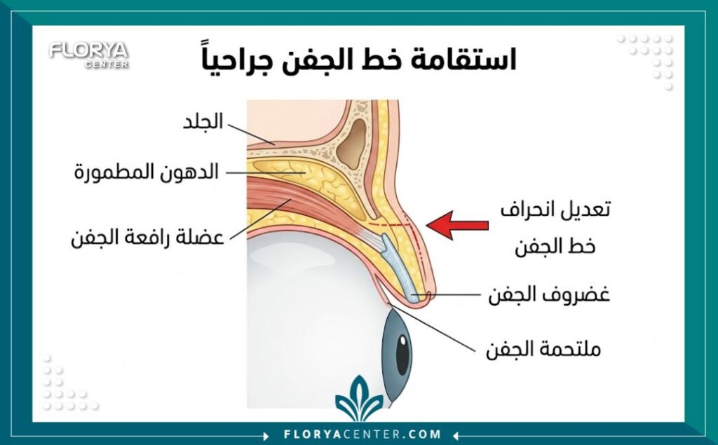 رسم تخطيطي طبي يوضح تشريح الجفن العلوي والعضلات المعنية بعملية استقامة خط الجفن جراحياً مع تسميات باللغة العربية.