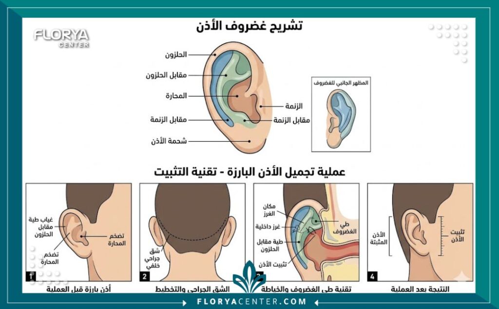 مخطط طبي يوضح تشريح الأذن وكيفية إجراء عملية تجميل الأذن الخفاشية.