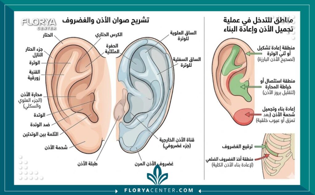 رسم توضيحي طبي يوضح تشريح غضاريف الأذن الخارجية وعملية ترميم صيوان الأذن.