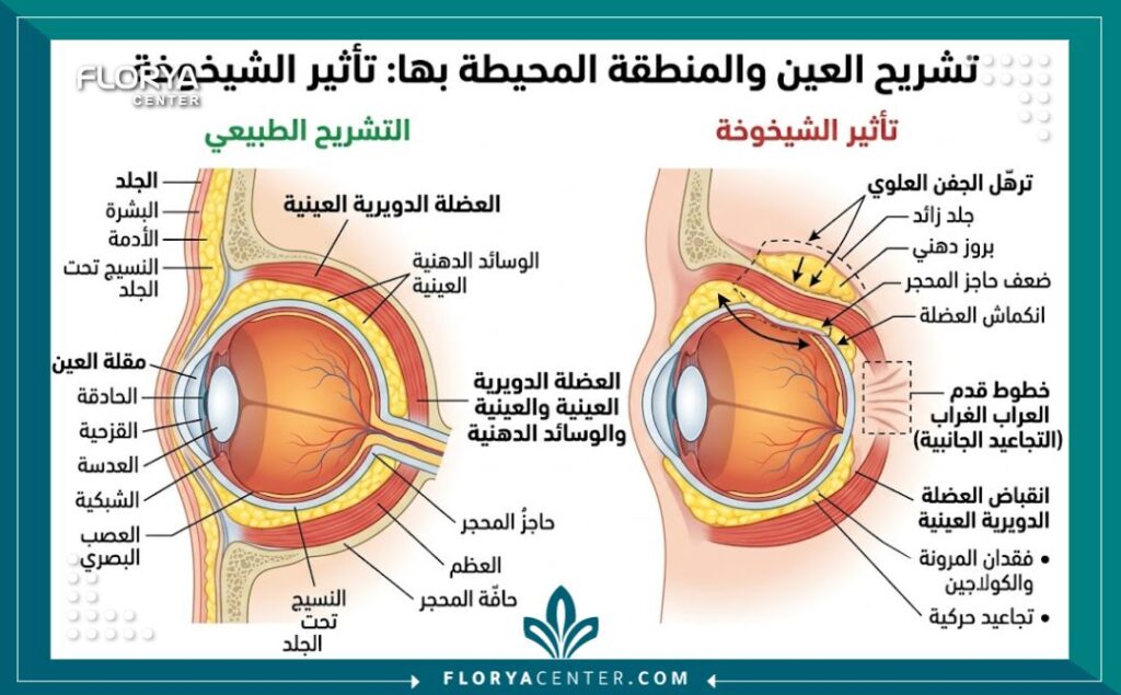 مخطط تشريحي يوضح أسباب ظهور تجاعيد العين وتهدل الجفون العلوية وعضلة محيط العين.