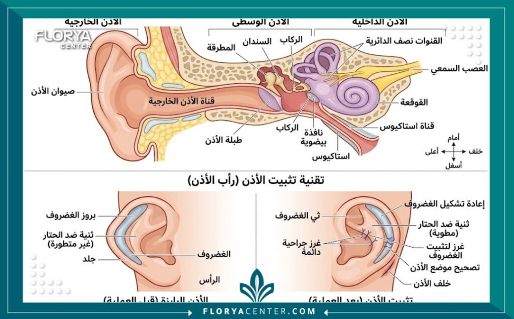 رسم توضيحي طبي يشرح تشريح الأذن وكيفية طي الغضروف لعلاج الأذن الخفاشية والبارزة.