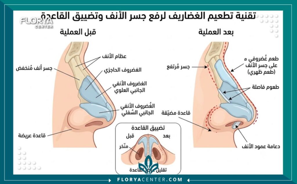 تجميل الأنف الأفطس في تركيا 2 رسم طبي يوضح تقنية زرع الغضاريف لرفع جسر الأنف وتصغير القاعدة العريضة.