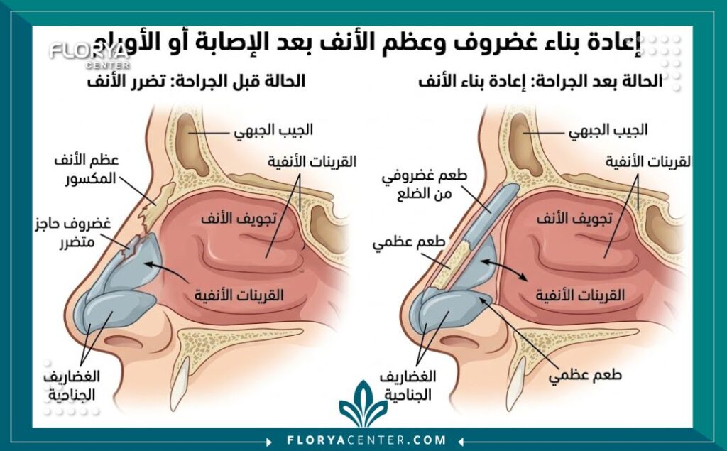 رسم توضيحي طبي يشرح تشريح الأنف وكيفية إعادة بناء الغضاريف في تجميل الأنف الترميمي