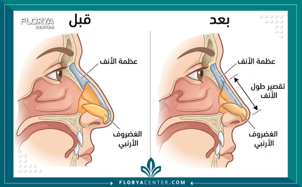 رسم تخطيطي طبي يوضح تشريح الأنف الطويل قبل وبعد عملية التقصير لتعديل الغضاريف والعظام.