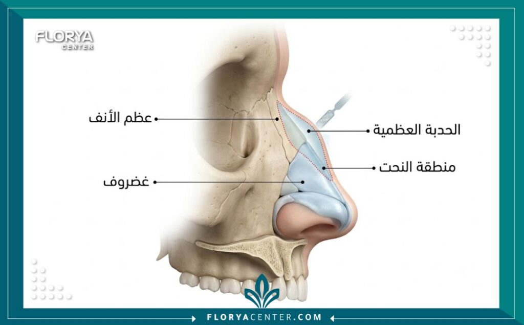 مخطط طبي يوضح تشريح الأنف العظمي ومكان إزالة الحدبة ونحت العظم في العملية.