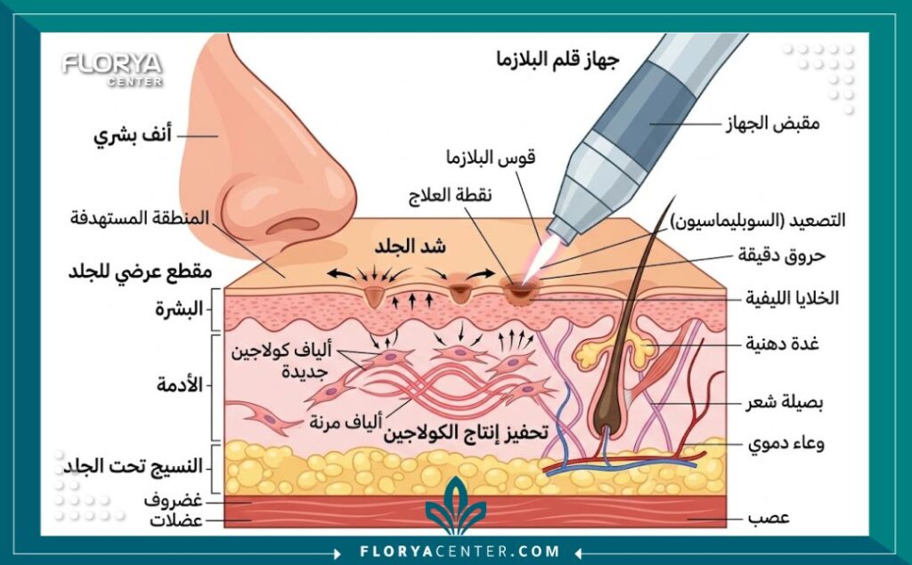 رسم توضيحي طبي يوضح آلية عمل جهاز البلازما لشد الجلد وتصغير الأنف اللحمي عن طريق النقاط الحرارية.