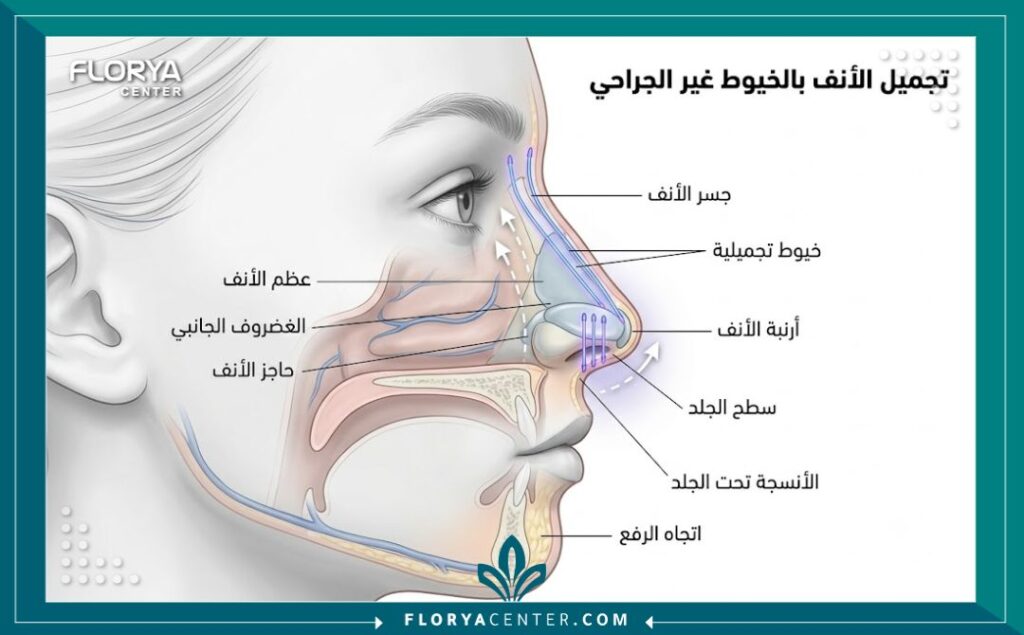 رسم توضيحي طبي دقيق يوضح آلية رفع أرنبة الأنف وتجميل الأنف بالخيوط التجميلية بدون جراحة.