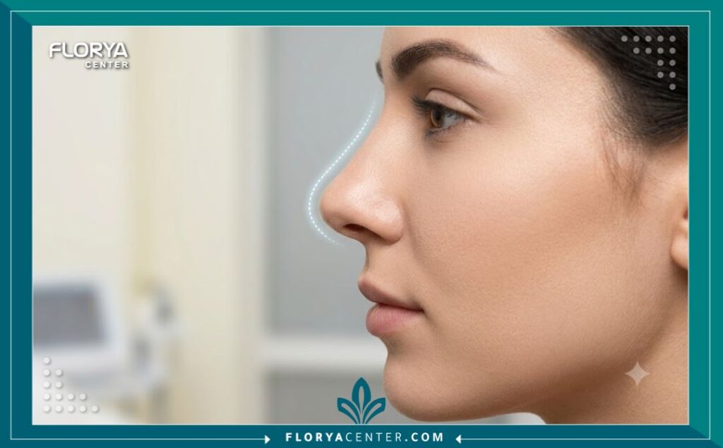 لقطة مقربة توضح جمال واستقامة أرنبة الأنف بعد إجراء التجميل غير الجراحي بالخيوط.
