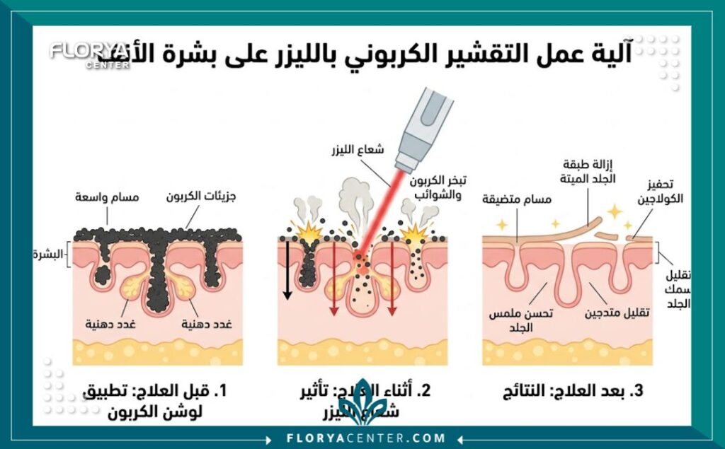 تجميل الأنف بتقنية الليزر الكربوني 2 رسم توضيحي طبي يوضح كيف يعمل تجميل الأنف بالليزر الكربوني على تقليص المسامات الواسعة للأنف اللحمي.