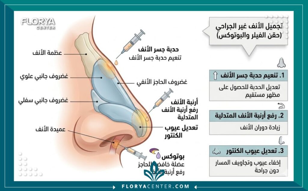 تجميل الأنف غير الجراحي في تركيا 2 رسم توضيحي طبي يوضح مناطق حقن الفيلر والبوتوكس لتعديل شكل الأنف ورفع الأرنبة بدون جراحة.