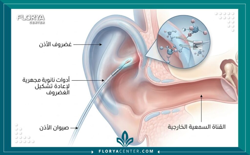 تجميل الاذن بتقنية النانو 2 رسم توضيحي طبي ثلاثي الأبعاد يشرح تشريح الغضروف وكيفية عمل تجميل الاذن بتقنية النانو بدقة متناهية.