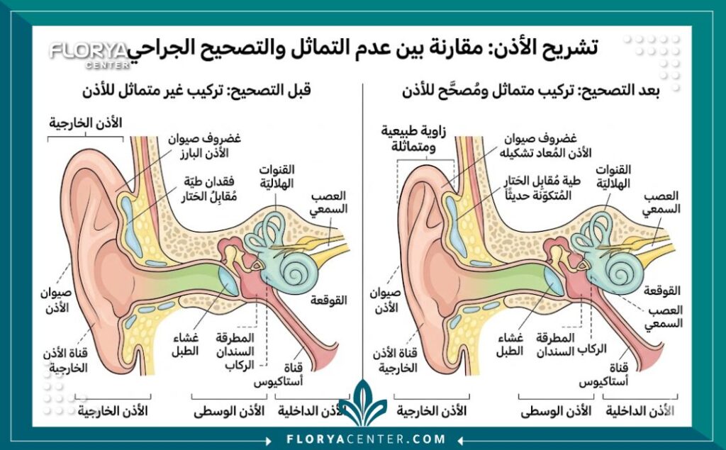 تجميل الاذن غير المتماثلة في تركيا 2 رسم توضيحي طبي يوضح تشريح الغضاريف قبل وبعد عملية تجميل الاذن غير المتماثلة.