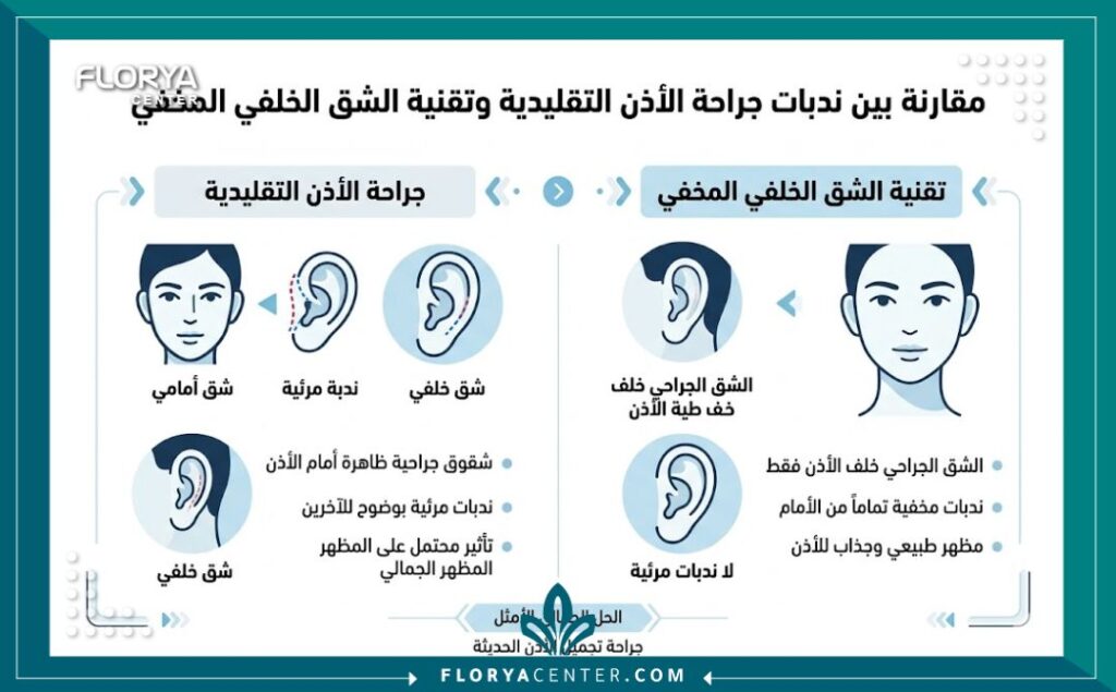 إنفوجرافيك يقارن بين تقنيات الجراحة ويوضح مميزات الشق المخفي في تجميل الاذن من الخلف لضمان عدم ظهور أي ندبات.