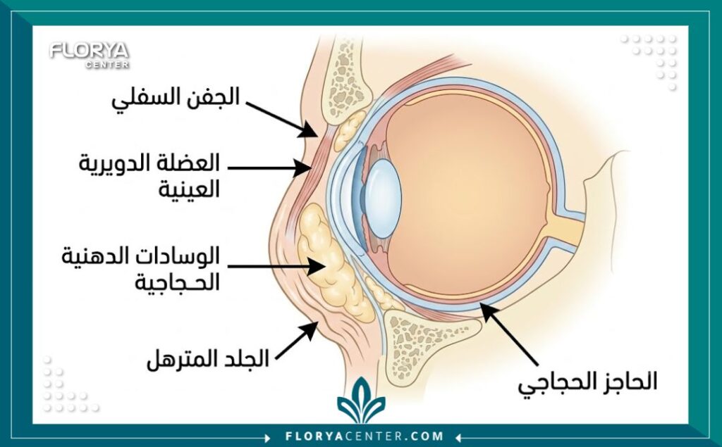  رسم توضيحي لتشريح الجفن السفلي يوضح الأكياس الدهنية والجلد المترهل قبل عملية التجميل.