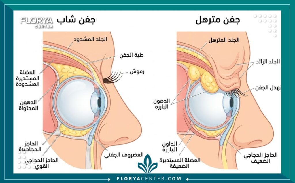 رسم طبي يوضح تشريح الجفن المترهل وأسباب ظهور الجلد الزائد والانتفاخات