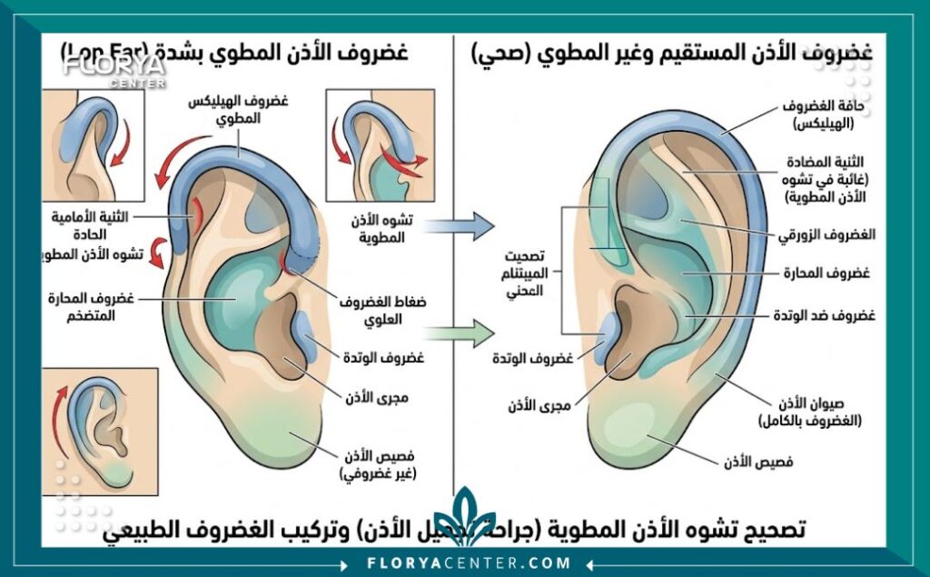 تجميل انكماش صيوان الاذن 2 رسم توضيحي طبي يوضح تشريح الغضاريف قبل وبعد جراحة فك وتمديد انكماش صيوان الاذن.
