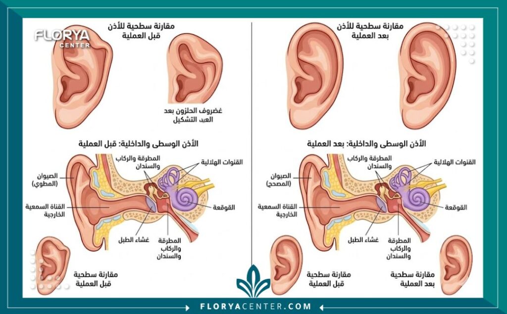رسم توضيحي طبي يقارن بين تشريح الأذن المطوية للداخل ونتائج علاج طية الأذن من الأعلى للحصول على أذن مستقيمة.