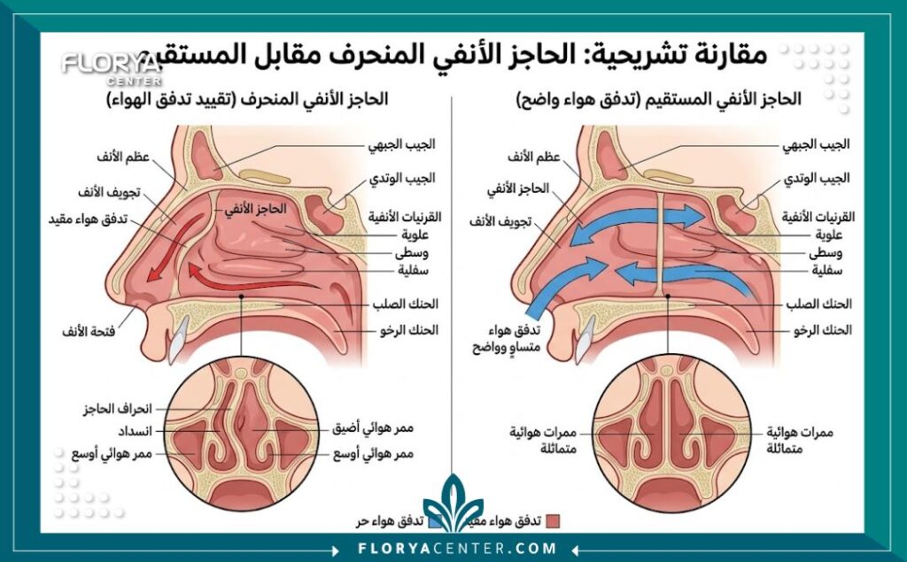 رسم توضيحي طبي مفصل يوضح الفرق بين الحاجز الأنفي المنحرف والسليم وكيفية تأثيره على انسداد الأنف والتنفس.