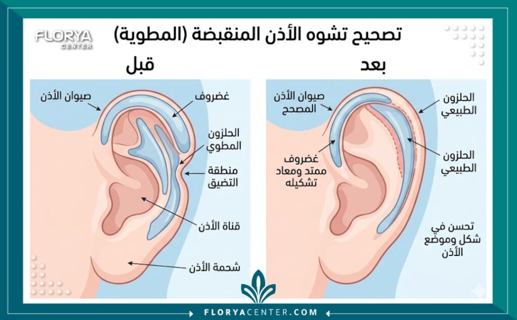 رسم طبي تشريحي يوضح شكل الغضاريف المطوية قبل وبعد تصحيح انكماش الأذن الخلقي جراحيا.