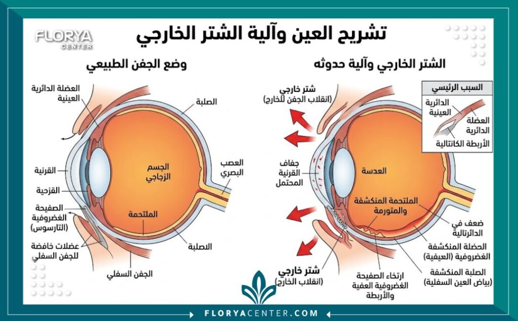 تصحيح ترهل الجفن السفلي الجراحي 2 رسم توضيحي طبي يشرح تشريح العين وضعف العضلات المسبب لترهل الجفن السفلي وانكشاف بياض العين.