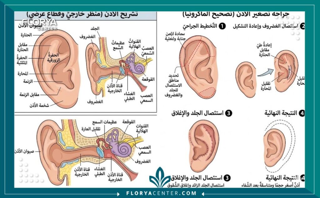 رسم طبي توضيحي يشرح التركيب التشريحي لغضروف الأذن وخطوات الجراحة في عملية تصغير الأذن الكبيرة جداً.