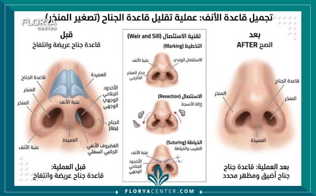 تصغير خياشيم الأنف في تركيا 2 رسم توضيحي طبي دقيق يشرح تشريح الأنف وكيفية إجراء عملية تصغير فتحات الأنف (أرنبة الأنف) طبياً.