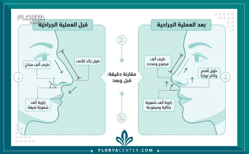 إنفوجرافيك يقارن زاوية الأنف قبل وبعد تجميل الأنف الطويل وتعديل المسافة بين الأنف والشفة العلوية.