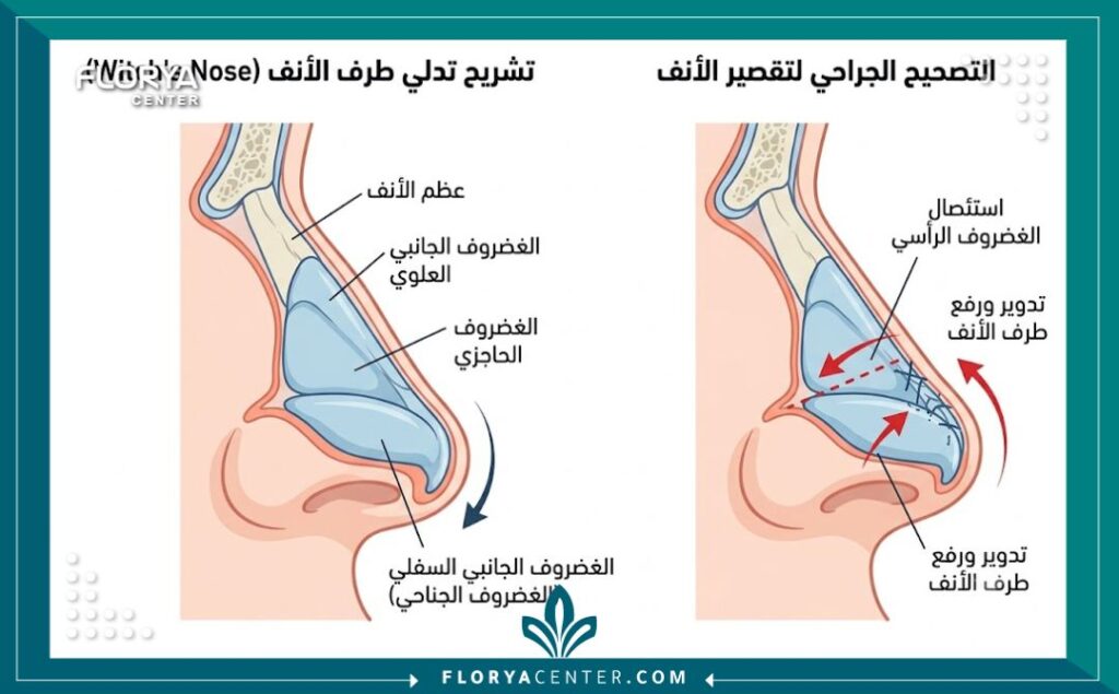رسم توضيحي طبي يشرح تشريح الغضاريف في الأنف الساحر وكيفية تقصير أرنبة الأنف الطويلة جراحياً.