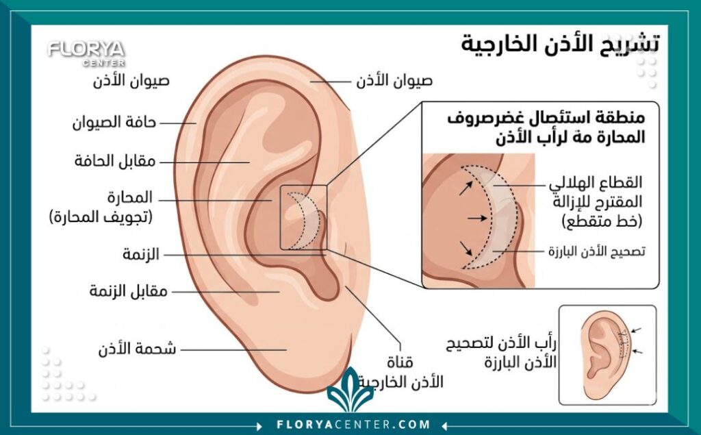 تقنية الاستئصال الغضروفي الجزئي 2 رسم توضيحي طبي يشرح آلية إزالة هلال من الغضروف العميق في تقنية الاستئصال الغضروفي الجزئي.