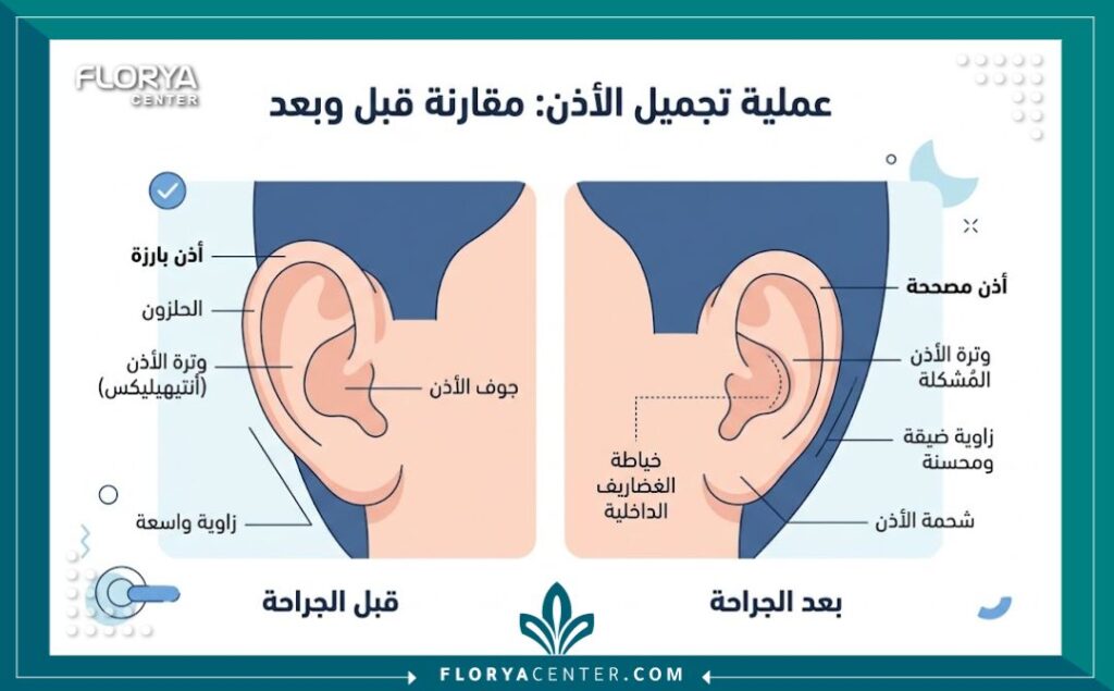 تقنية الخياطة الداخلية لتشكيل طية الأذن 3 إنفوجرافيك يقارن بين شكل الأذن البارزة قبل العملية والنتيجة النهائية بعد تشكيل طية الأذن باستخدام الخيوط الجراحية الداخلية.