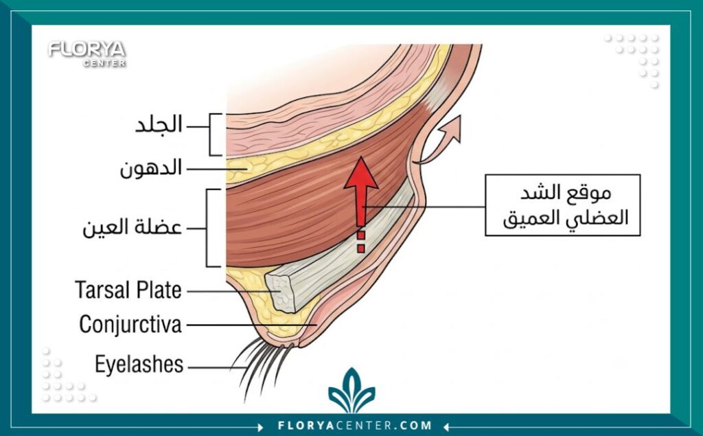 مخطط تشريحي طبي يوضح تقنية الشد العضلي العميق للجفن مقابل شد الجلد السطحي فقط، مع تسميات عربية.