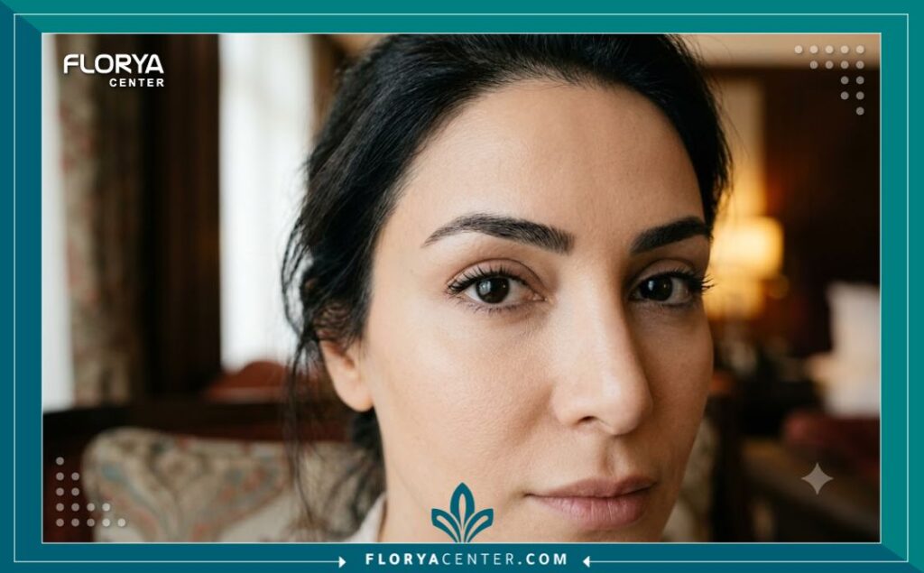لقطة جمالية قريبة تظهر عيونًا مشدودة ومرفوعة بشكل طبيعي بعد عملية الشد العضلي للجفون في تركيا، خالية من الندبات السطحية.