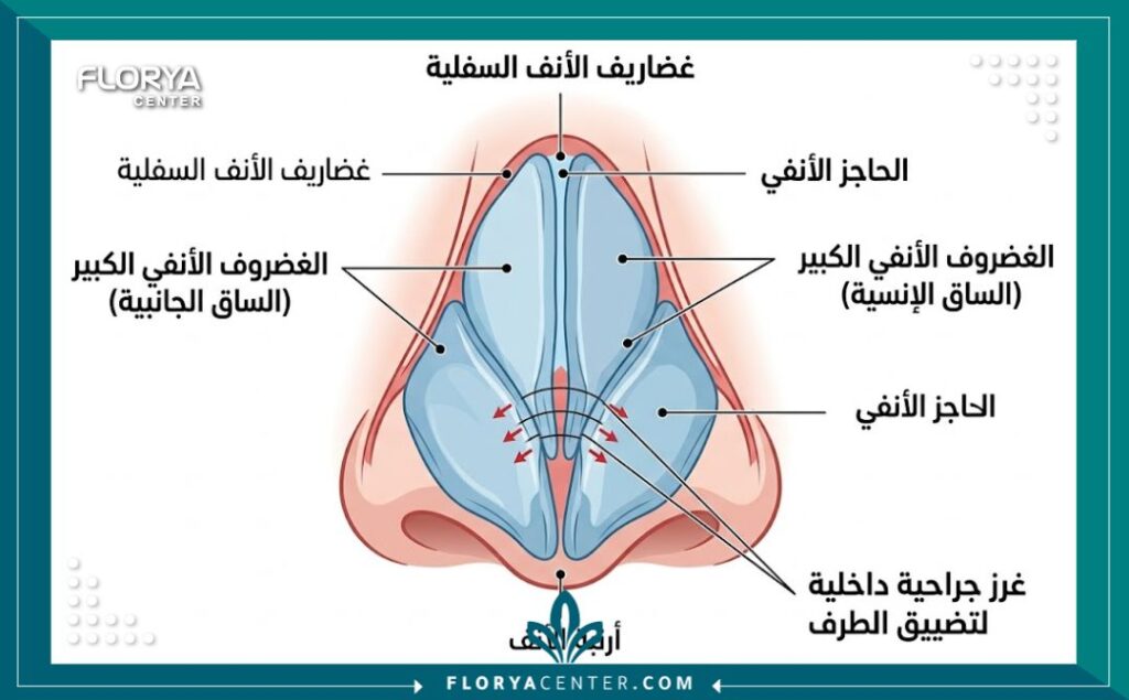 تقنية الغرز الداخلية للأرنبة في تركيا 2 رسم توضيحي طبي دقيق يشرح آلية عمل تقنية الغرز الداخلية لتضييق وتشكيل غضاريف أرنبة الأنف من الداخل.