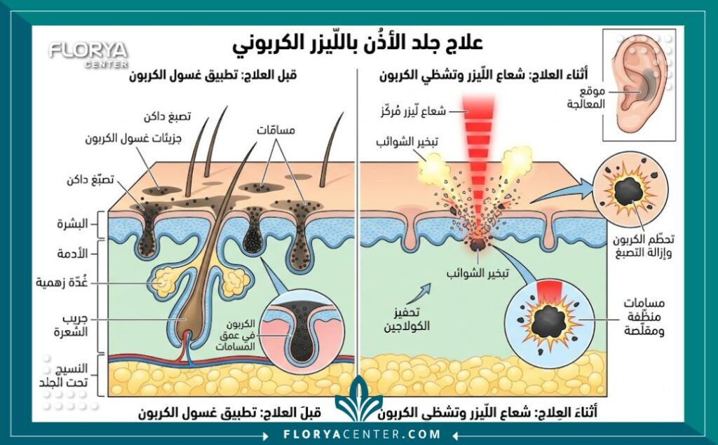 رسم توضيحي طبي يشرح آلية عمل تقنية الليزر الكربوني للاذن في إزالة التصبغات وتجديد الخلايا.