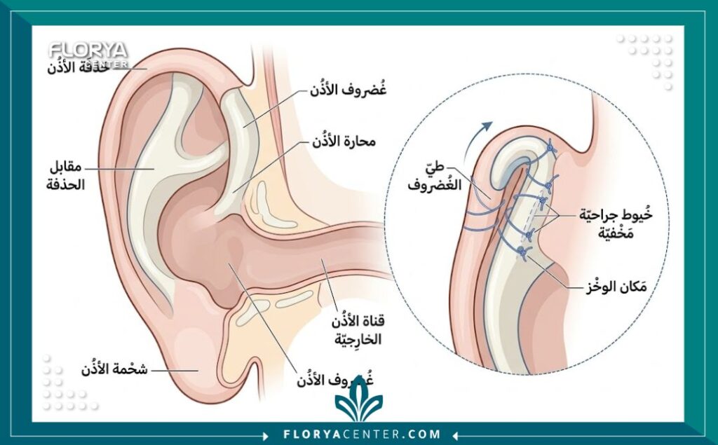رسم توضيحي طبي يوضح تقنية تقويم الأذن بالخيوط المخفية بدون جراحة لطي الغضروف بدقة وأمان.