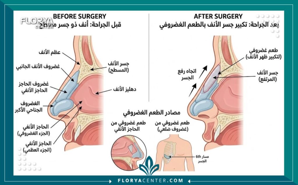 تكلفة تجميل الأنف الأفطس في تركيا 2 مخطط طبي يوضح عملية زراعة الغضاريف لإعادة بناء جسر الأنف الأفطس.