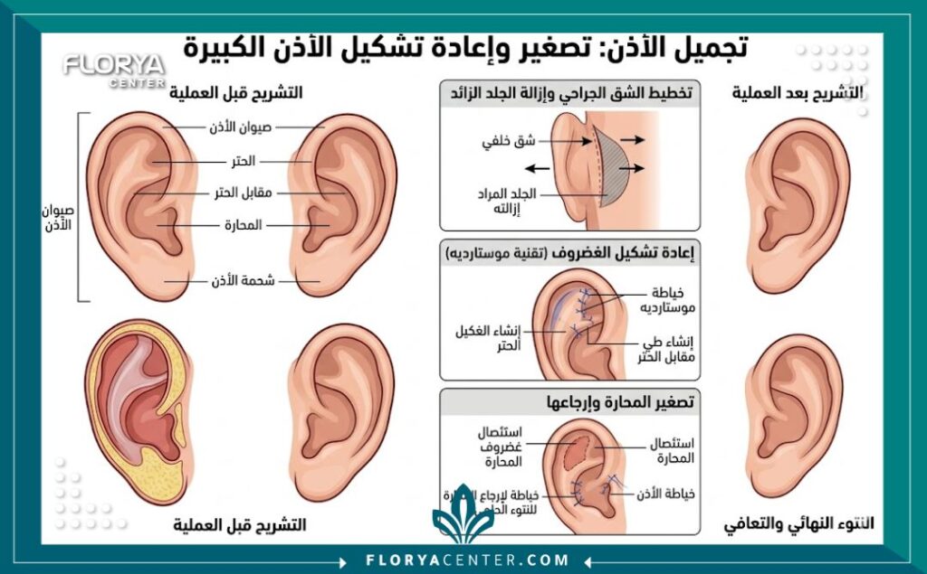 تكلفة تصغير الاذن الكبيرة في تركيا 2 مخطط طبي يوضح طريقة قص غضروف الأذن وإزالة الجلد الزائد لتصغير الأذن الكبيرة