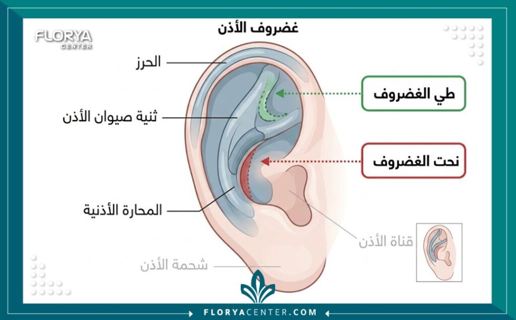 مخطط طبي يوضح تشريح غضروف الأذن والمناطق المستهدفة في عملية نحت وطي الغضروف المعاند.