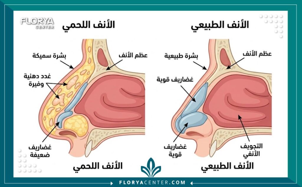 مخطط طبي يوضح تشريح الأنف اللحمي وسمك الجلد الذي يتطلب مهارة خاصة في جراحة التجميل.
