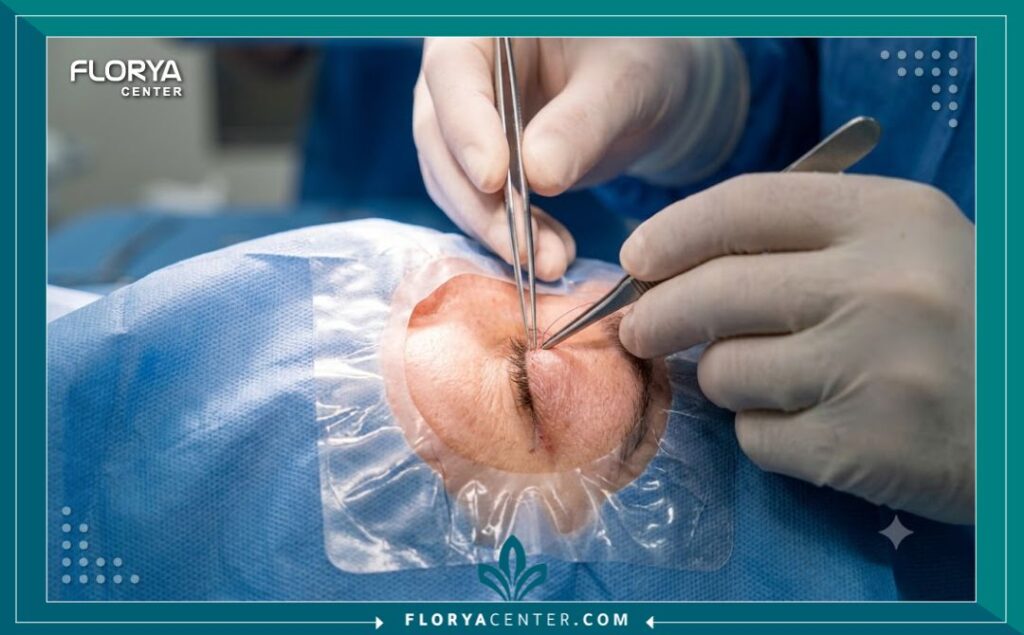 لقطة مقربة تظهر دقة جراح التجميل أثناء إجراء عملية تصحيح تماثل الجفون في غرفة عمليات معقمة وحديثة في اسطنبول.