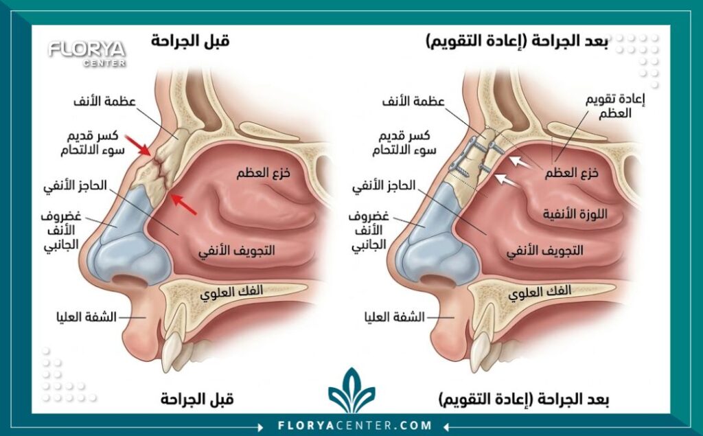 رسم توضيحي طبي ثلاثي الأبعاد يشرح تشريح الأنف وكيفية إعادة تثبيت كسر العظم الملتئم بشكل خاطئ.