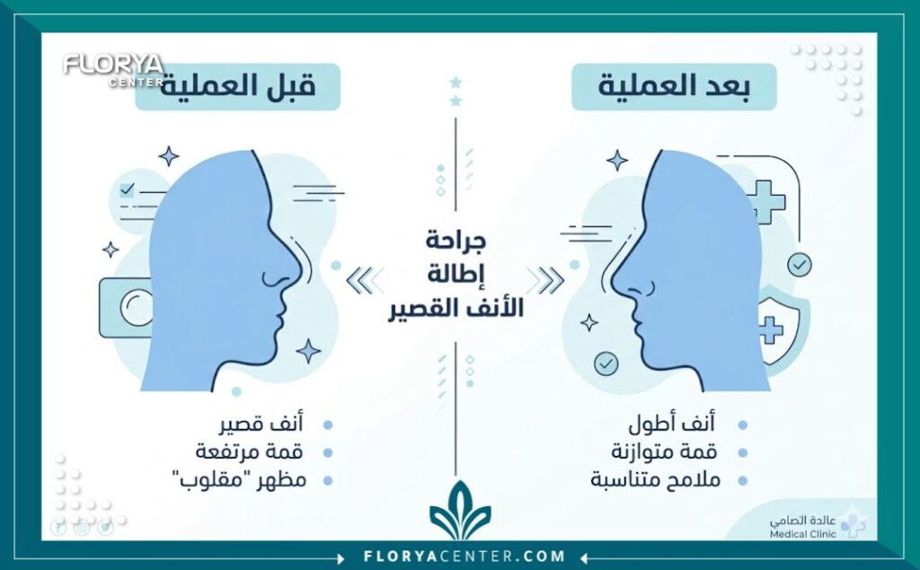 إنفوجرافيك يقارن بين شكل الأنف القصير المرفوع قبل وبعد عملية الإطالة الجراحية وتعديل الأرنبة.