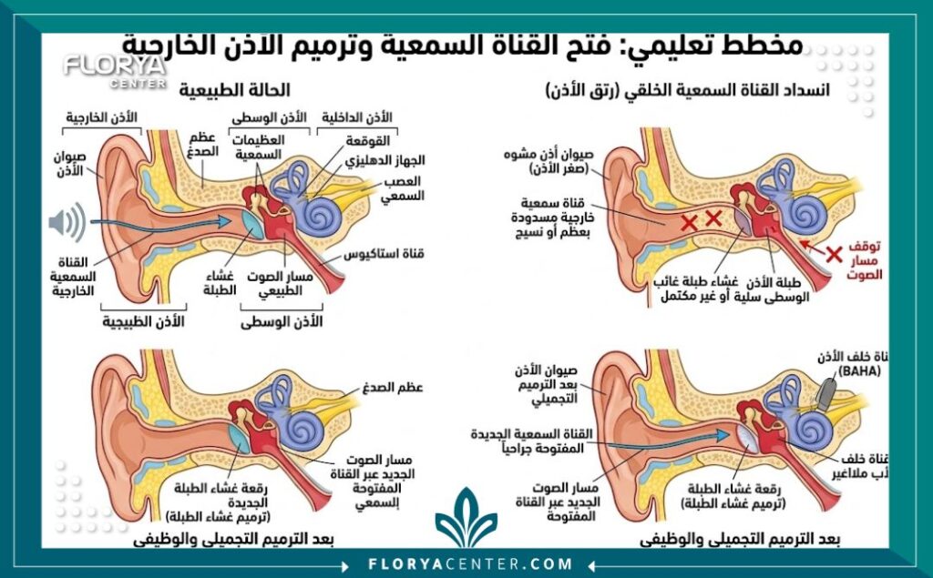 رسم توضيحي طبي يشرح التشريح الداخلي للأذن وخطوات عملية فتح قناة الأذن المغلقة وإعادة بنائها تجميلياً.