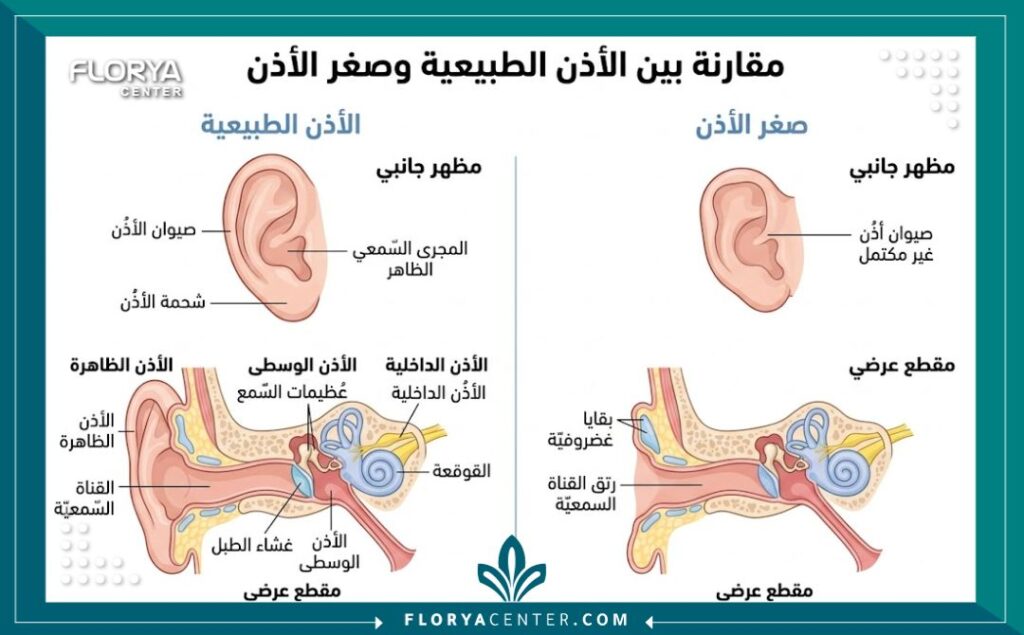 جراحة الأذن الصغيرة في تركيا 2 رسم تشريحي طبي يوضح درجات صغر صيوان الأذن (المايكروتيا) قبل إجراء جراحة بناء الأذن المعقدة.