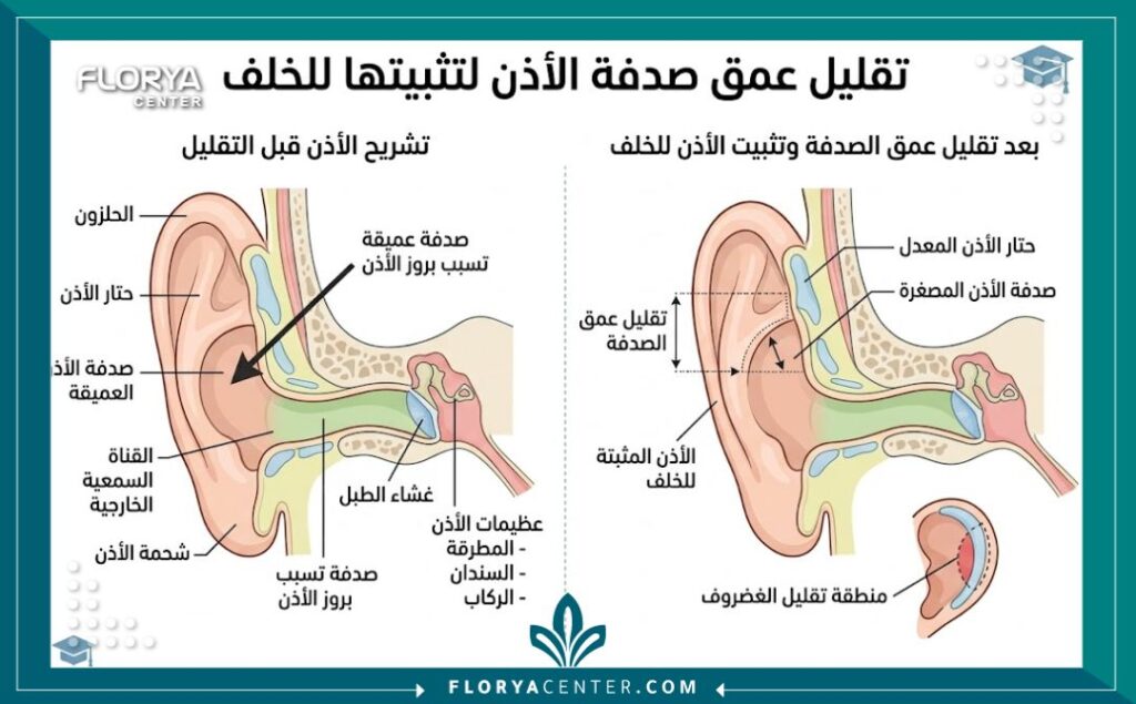 جراحة الأذن القوقعية في تركيا 2 رسم توضيحي لتشريح غضروف الأذن القوقعية وكيفية علاج بروز الأذن جراحيا.