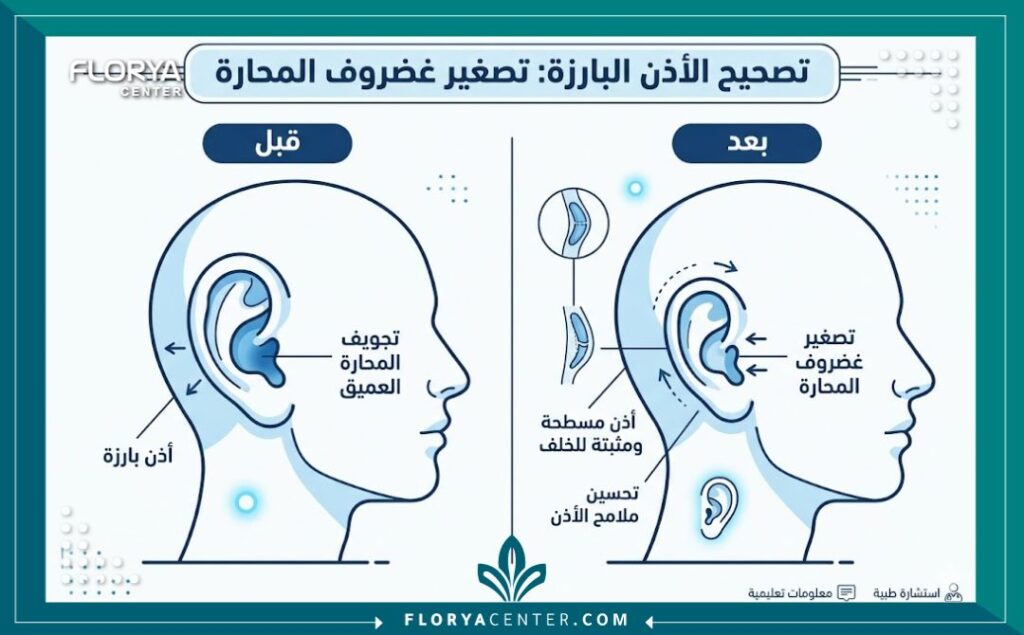 جراحة الأذن القوقعية في تركيا 3 إنفوجرافيك يوضح الفرق قبل وبعد عملية جراحة الأذن القوقعية في تركيا وطي الغضروف.
