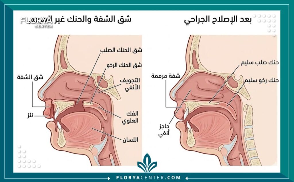 جراحة الأنف والشفة المشقوقة في تركيا 2 رسم توضيحي طبي يوضح تشريح الشفة الأرنبية وشق سقف الحلق قبل وبعد الجراحة الترميمية.