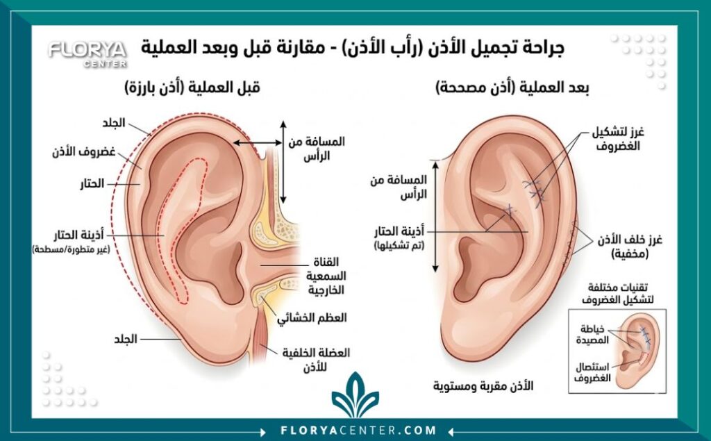 جراحة الاذن التجميلية في تركيا 2 رسم توضيحي طبي يشرح تشريح غضروف الأذن وخطوات تصحيح الأذن البارزة وتجميلها.