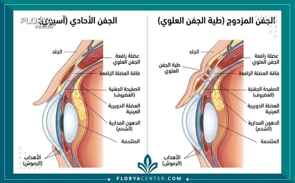 رسم توضيحي لتشريح العين قبل وبعد عملية الجفن المزدوج الآسيوية لتوسيع العيون المبطنة.