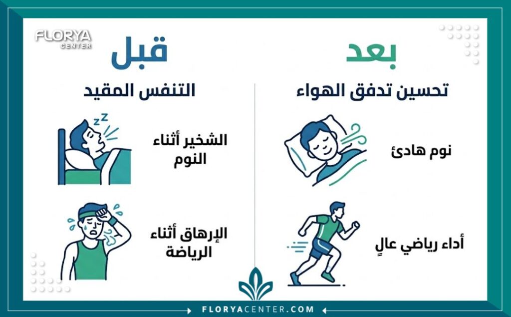 جراحة الصمام الأنفي في تركيا 3 إنفوجرافيك يقارن بين التنفس أثناء النوم والرياضة قبل وبعد عملية إصلاح تضيق الصمام الأنفي.